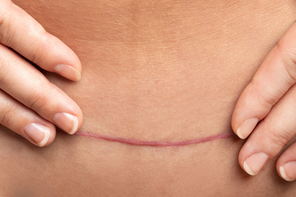Scar after C-Section Surgery on Female Belly